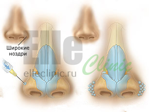 Сужение носа ботоксом схема