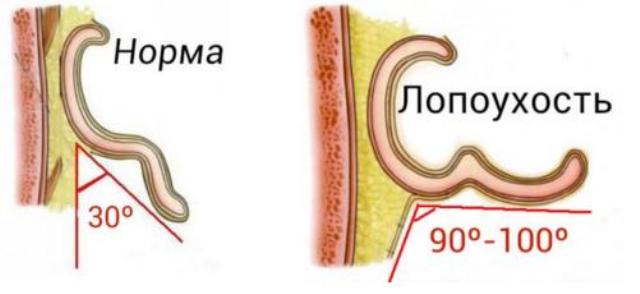 Нормальные уши. Нормы оттопыренности ушей. Как определить степень лопоухости.